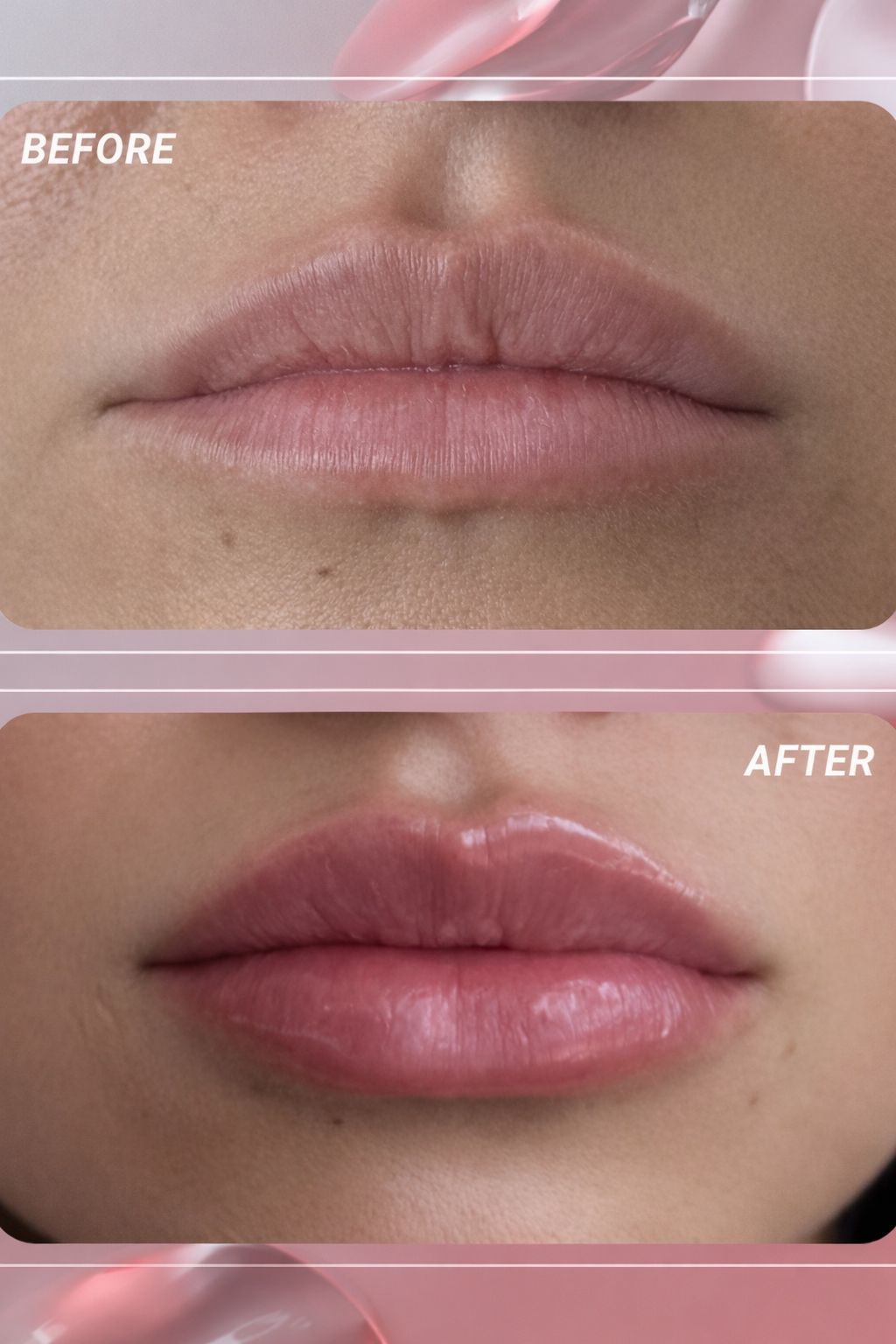 Lip fillers transformation showing before and after results with fuller, smoother lips.