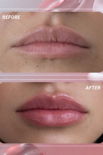 Lip fillers transformation showing before and after results with fuller, smoother lips.