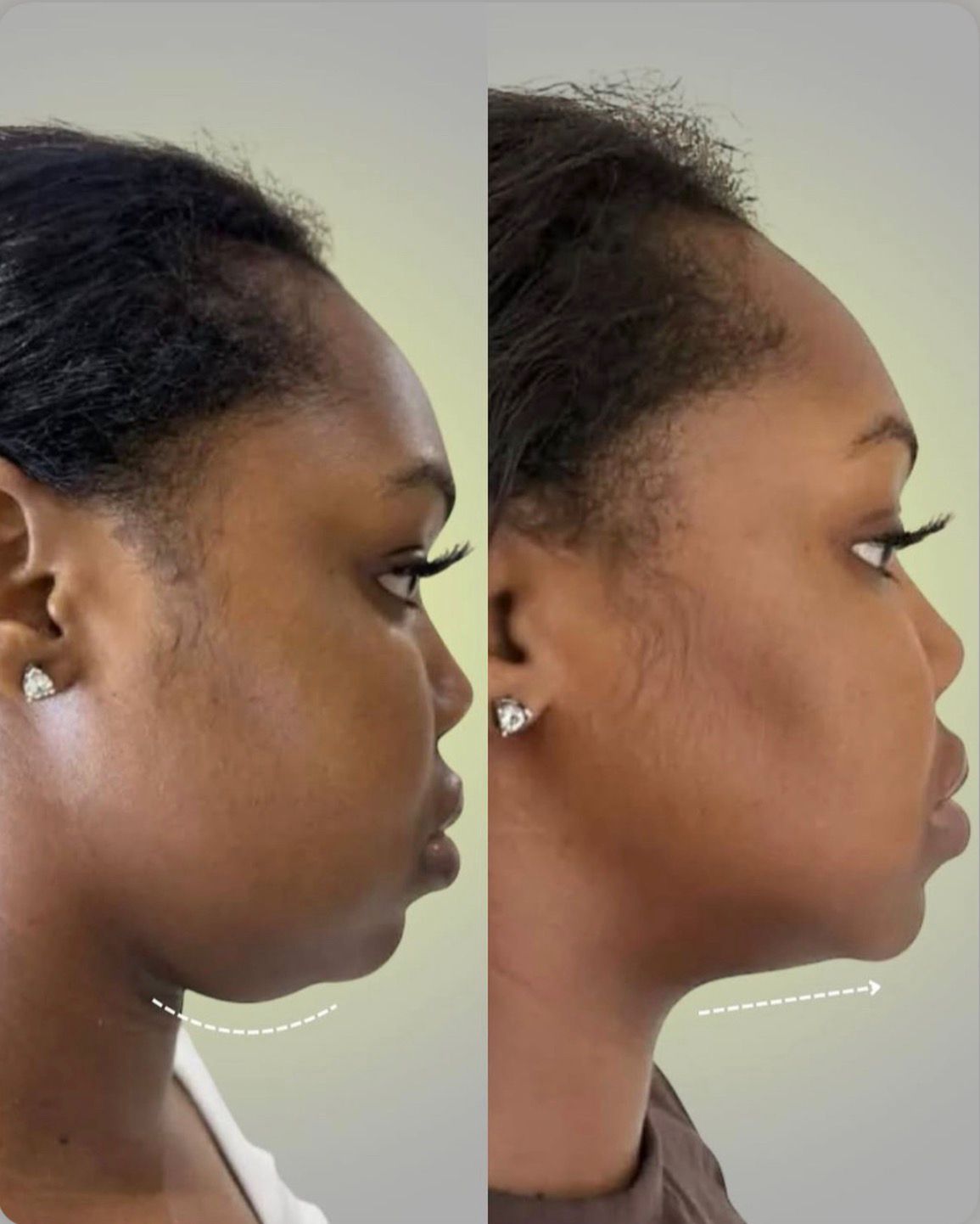Lyposhots PCDC Double Chin 1 Treatment: 250$ | 3 Treatments: 600$