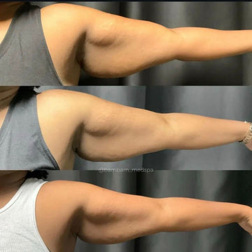 Lyposhots PCDC Body 1 Treatment: 350$ | 3 Treatments: 900$