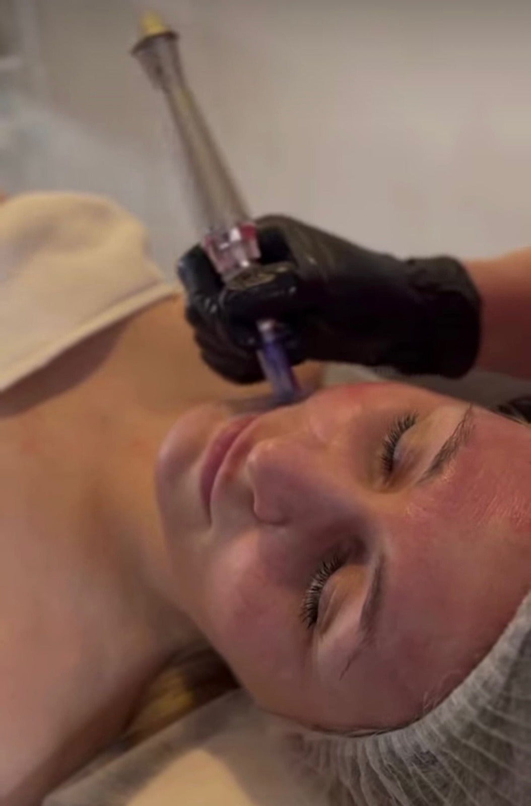 Salmon/PRP DNA Facial 1 Session: 600$ | 4 Sessions: 2000$