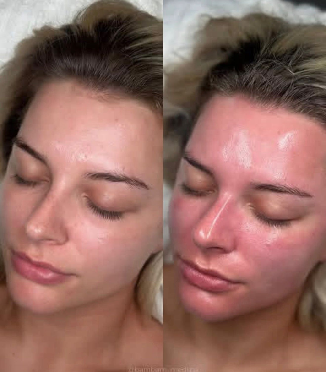 Salmon/PRP DNA Facial 1 Session: 600$ | 4 Sessions: 2000$