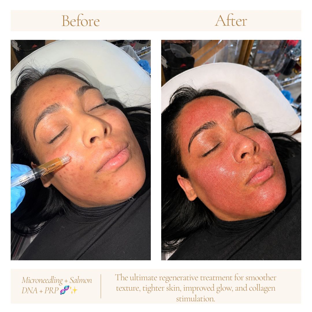 Microneedling with PRP