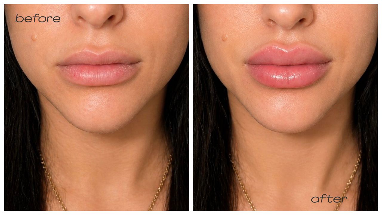 Lip fillers enhancing volume and shape, showcasing before and after results in a med spa setting.