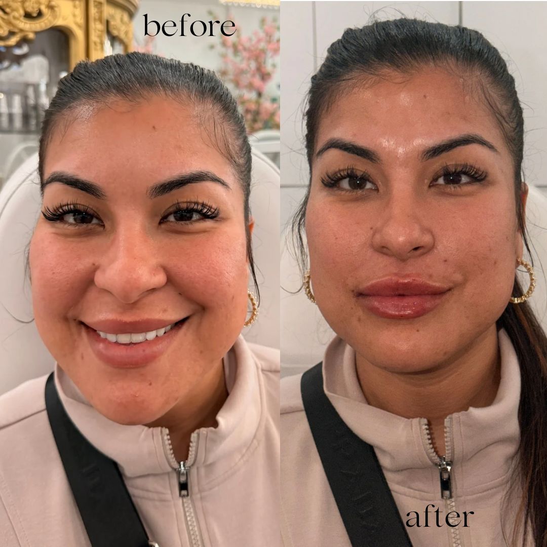 Nasolabial Fold Treatment
