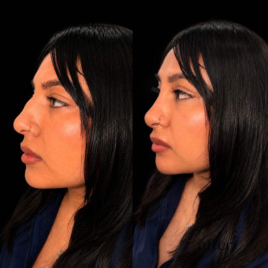 Non-Surgical Nose Filler
