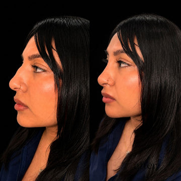 Non-Surgical Nose Filler