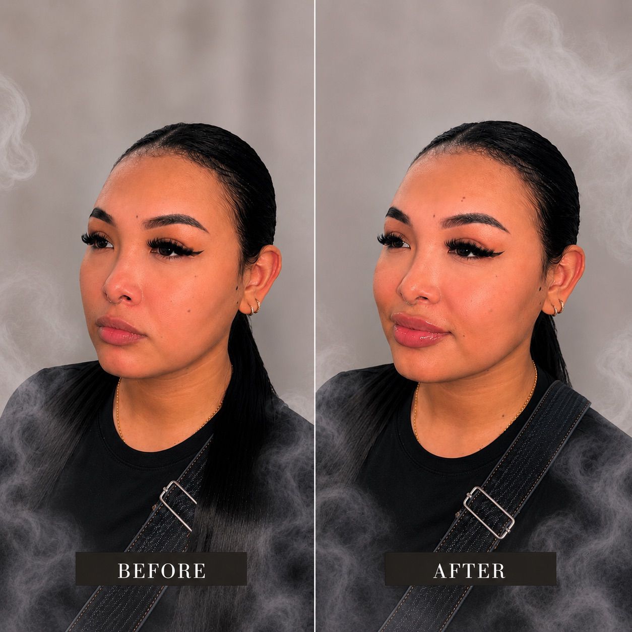 Natural Lip Enhancement