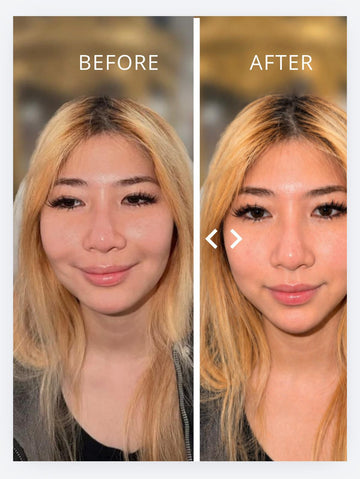 Chin Filler