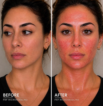 Microneedling with PRP