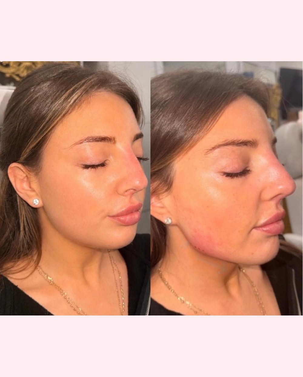 Before and after dermal filler treatment at Glow by Phoebe