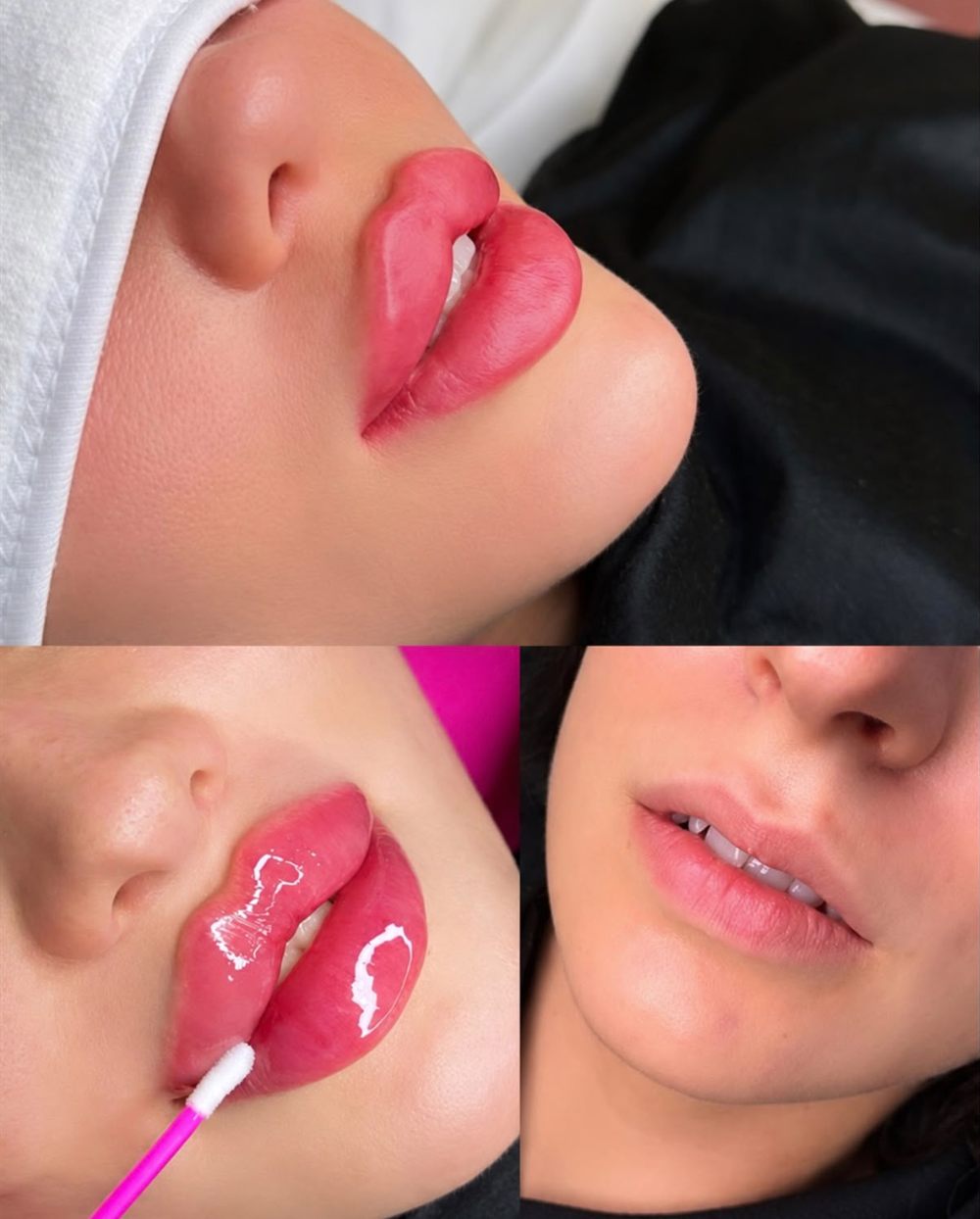 Lip filler used for Russian lips at Glow by Phoebe