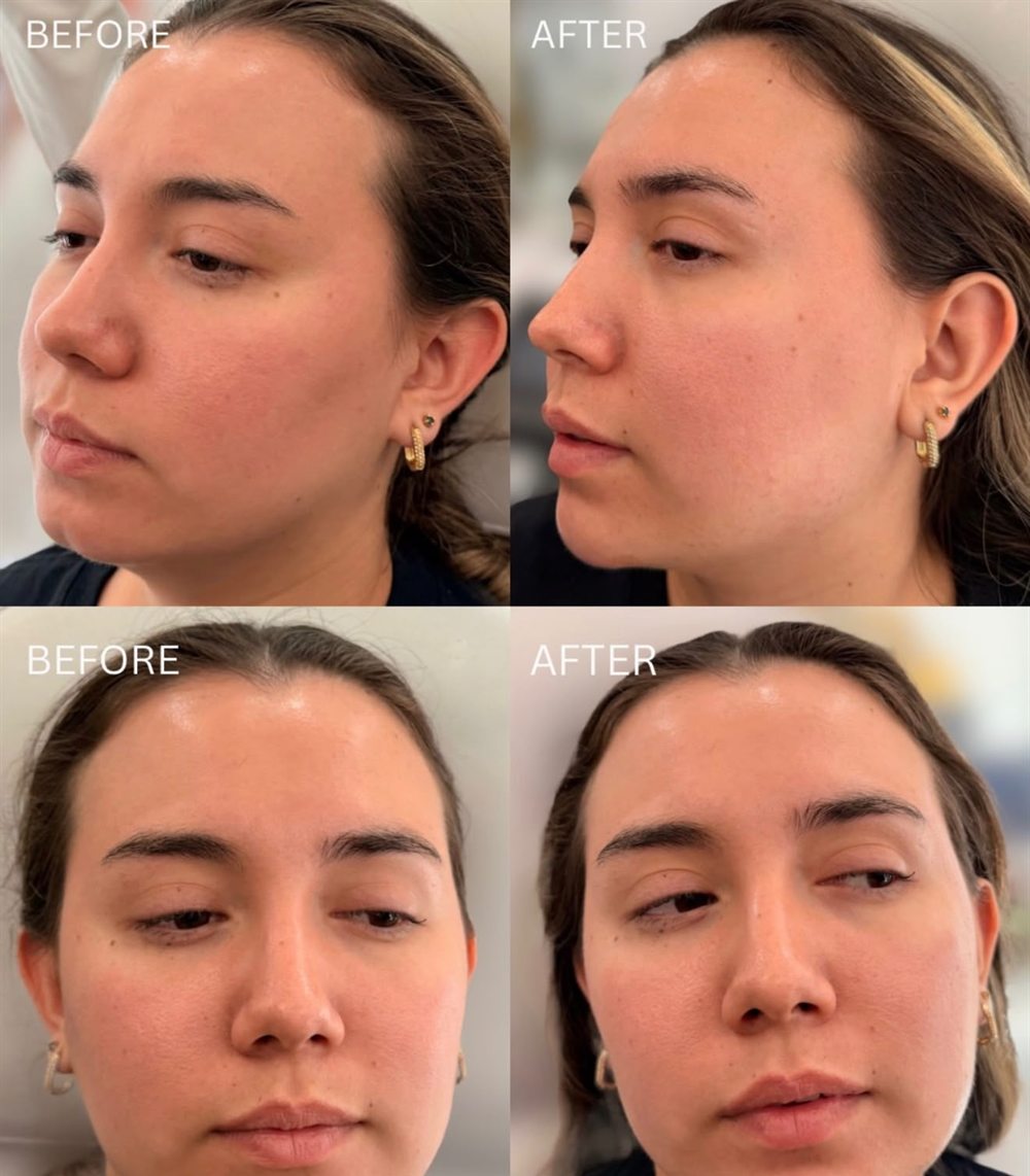 Before and after chin filler at Glow by Phoebe