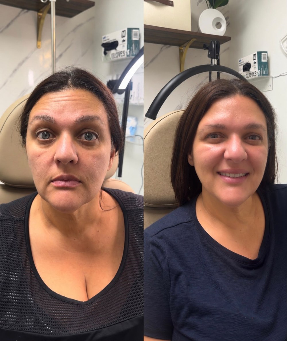 Before and after a wrinkle relaxer treatment at Glow by Phoebe: forehead lines softened and the brow relaxed