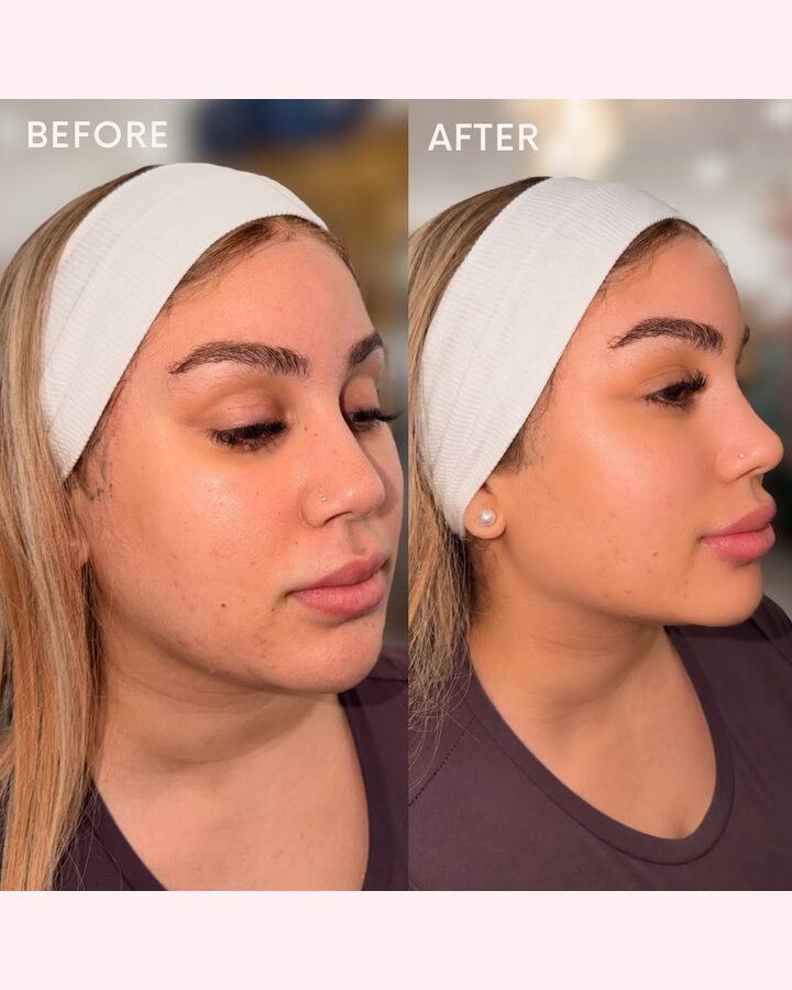 Before and after facial balancing at Glow by Phoebe