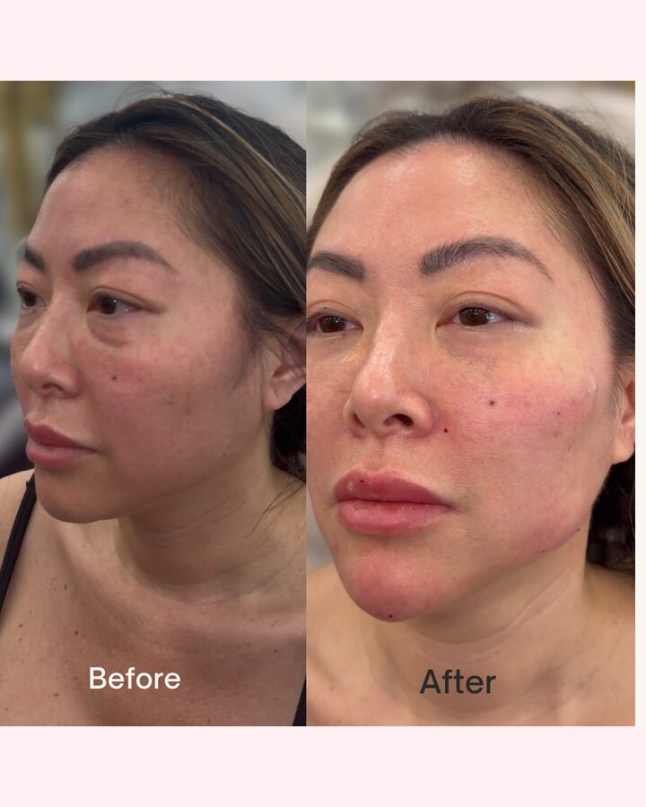 Before and after wrinkle relaxer treatment at Glow by Phoebe