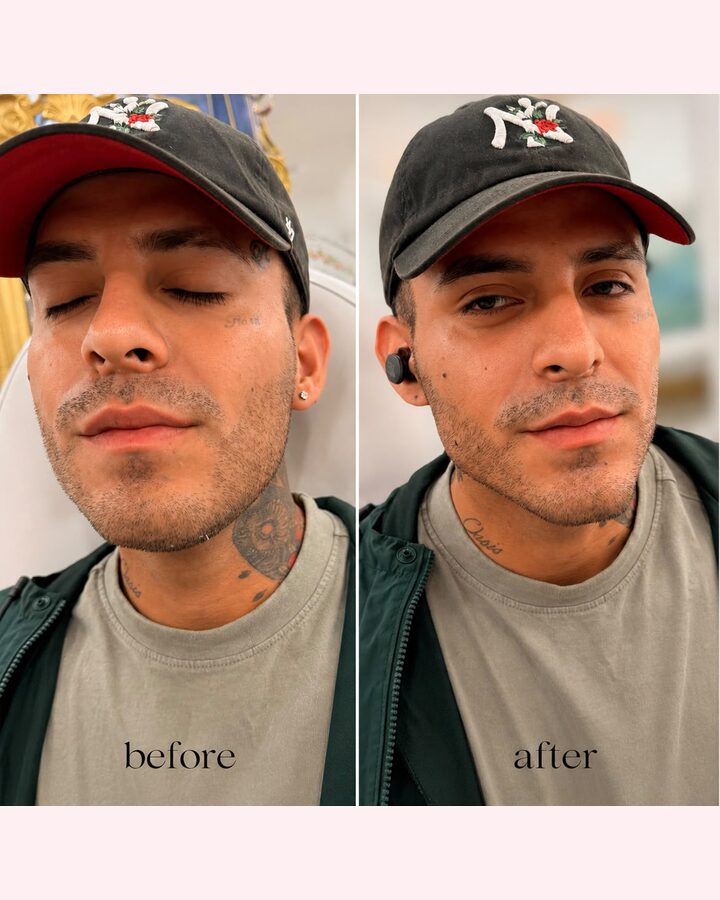 Before and after jawline definition