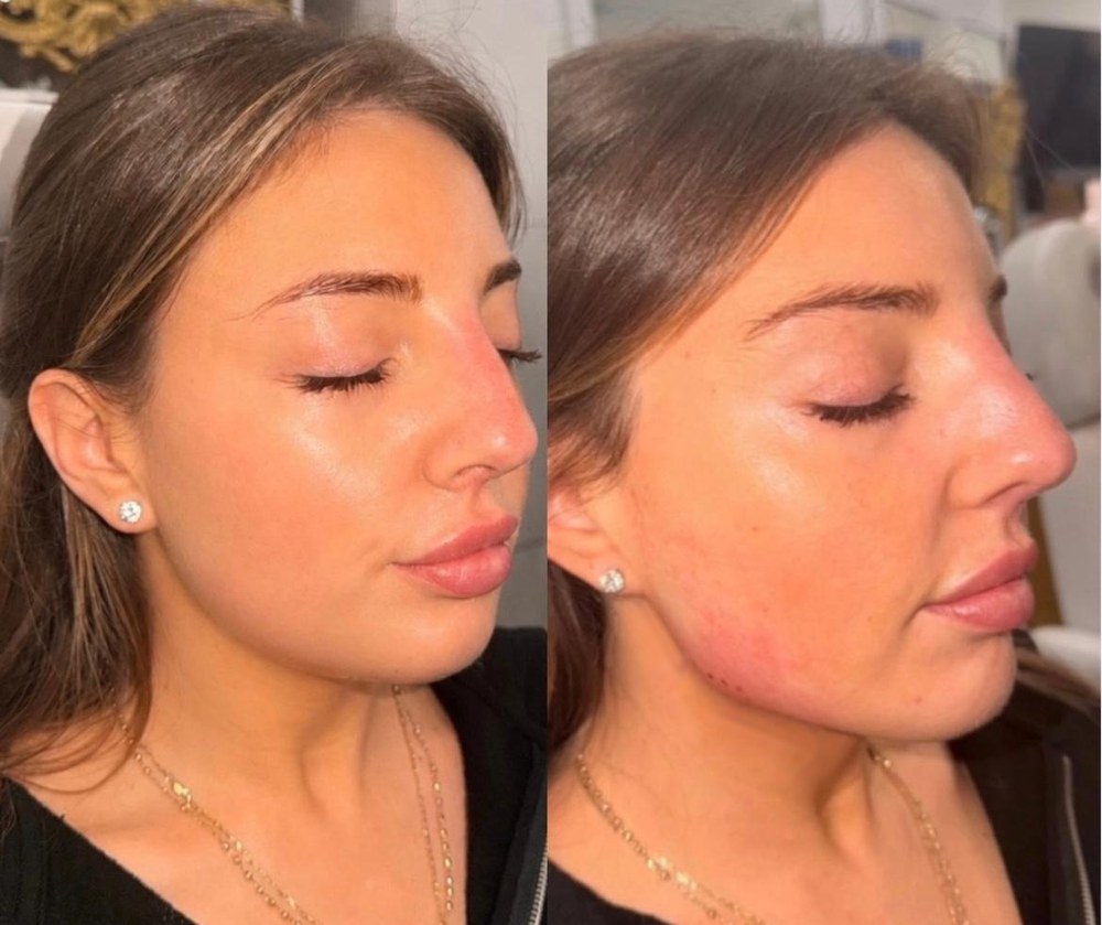Before and after facial balancing at Glow by Phoebe