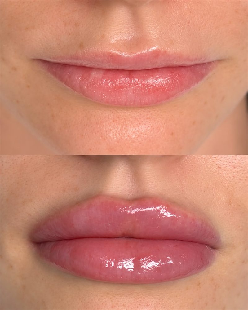 Before and after lip enhancement