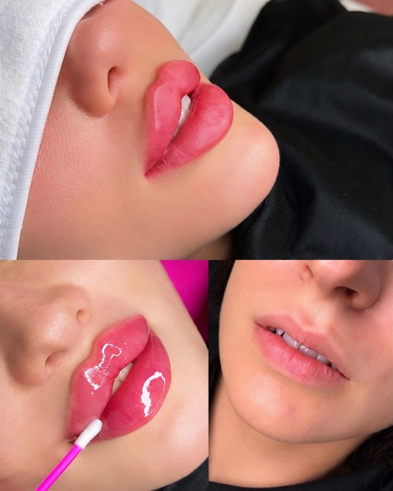 Lip filler results at Glow by Phoebe