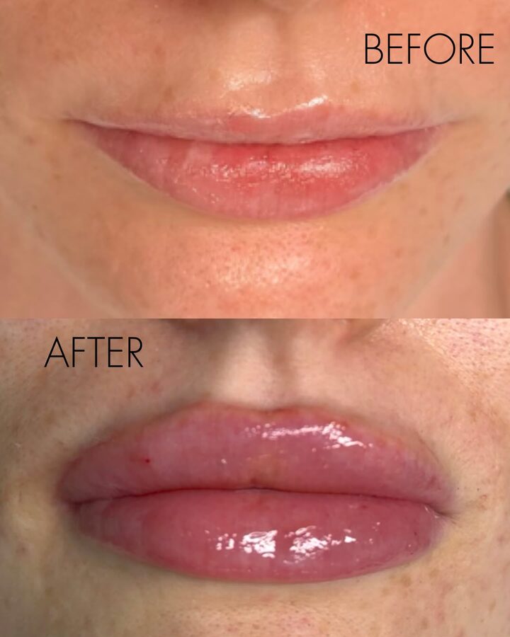 Before and after lip enhancement at Glow by Phoebe