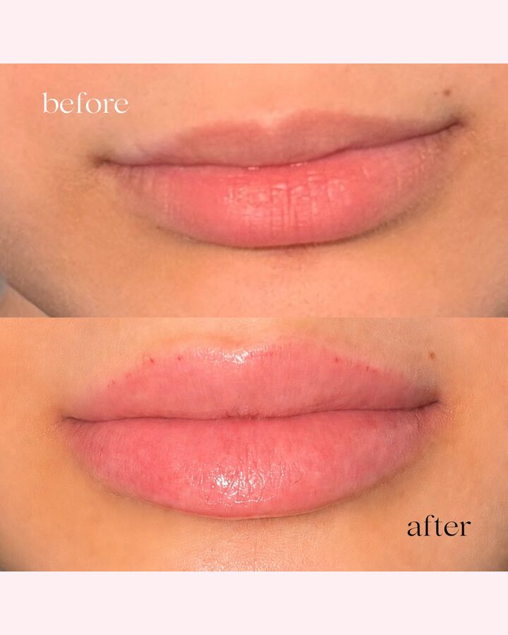 Before and after lip filler at Glow by Phoebe