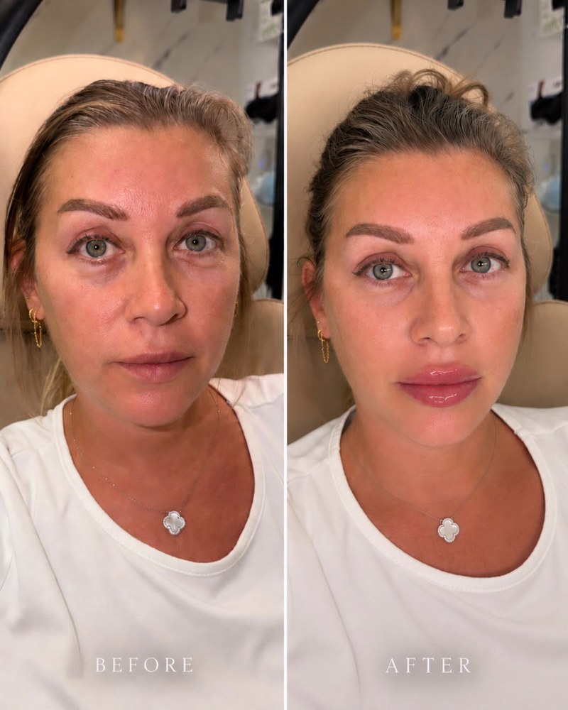 Before and after lip filler at Glow by Phoebe