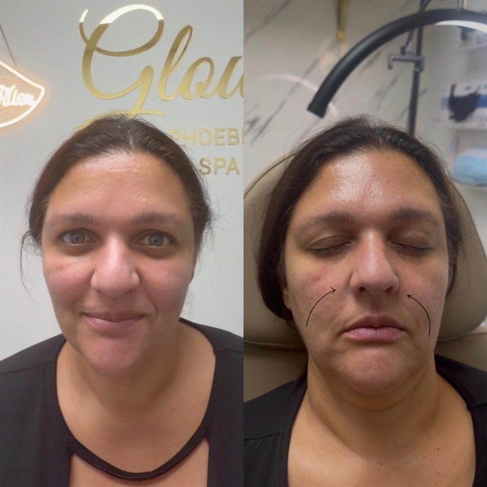 Before and after nasolabial fold filler at Glow by Phoebe